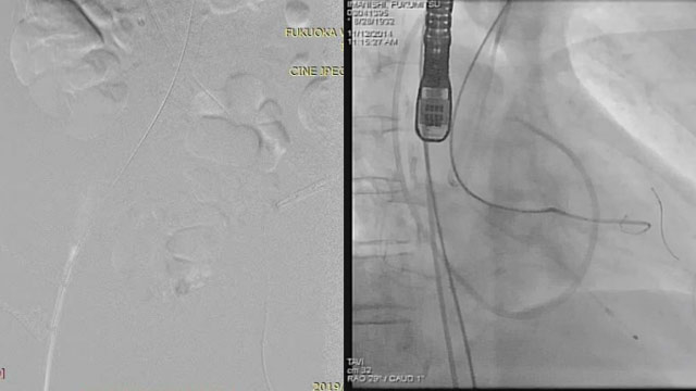 TAVI basics Co-Medicals - in Japanese