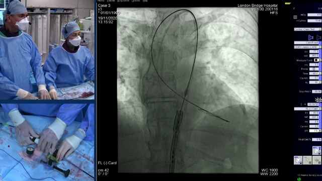 Virtual LIVE - TAVI in bicuspid case 