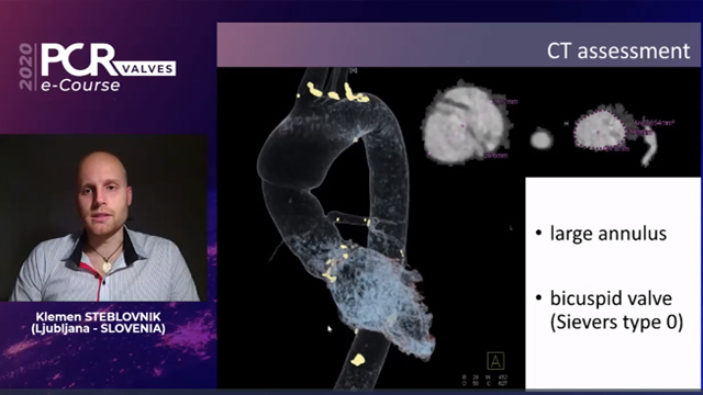 TAVI in challenging scenarios: patients with previous surgery on aortic root