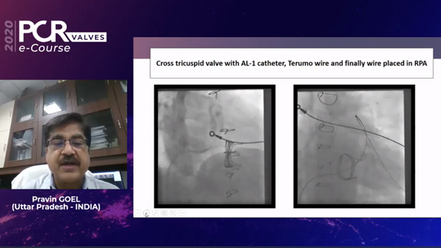 TAVI in no aortic position