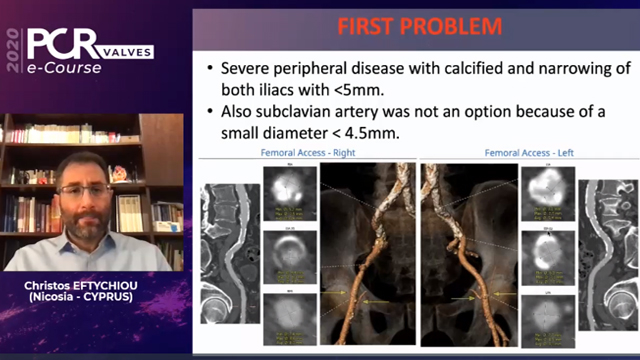 TAVI vascular access: Part 1