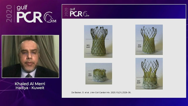 Transcatheter valve-in-valve procedure – Making tomorrow, today