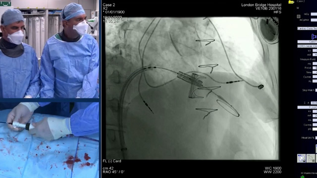 virtual LIVE case: Tricuspid valve-in-valve case
