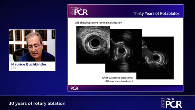 30 years of Rotary ablation