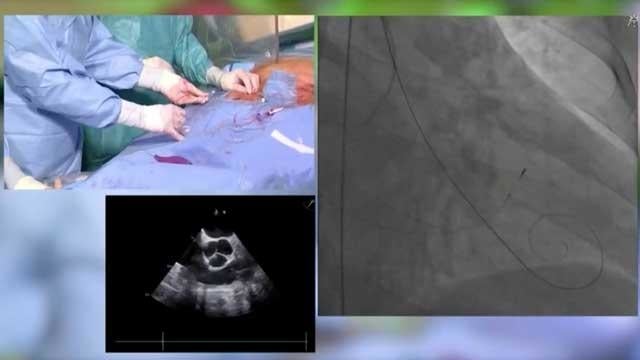 A new evolution: TAVR for aortic regurgitation with the JenaValve Trilogy System