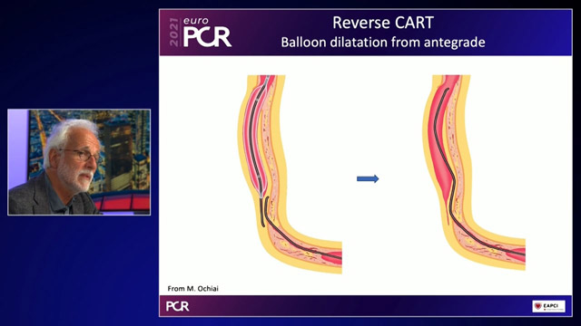 Advanced techniques for complex CTO interventions (Part 2)