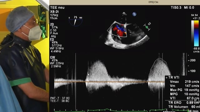 Advancing solutions for tricuspid regurgitation patients: introducing TriClip G4