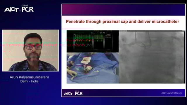Antegrade CTO intervention: the essentials you need to learn