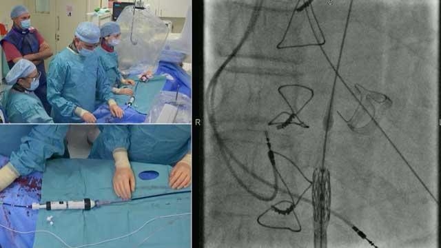 Aortic valve disease: guidelines and beyond