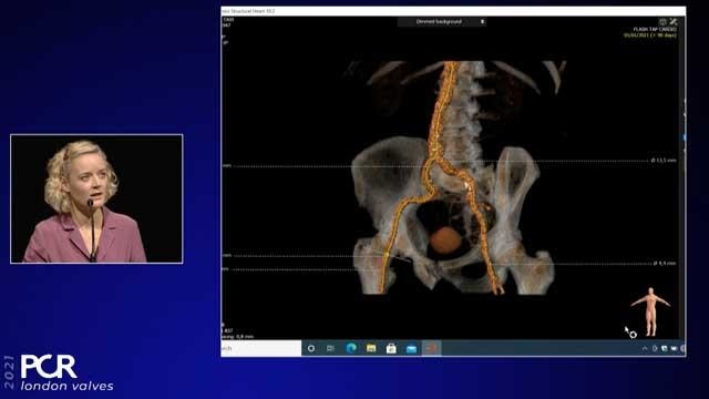 Aortic valve disease: state-of-the-art