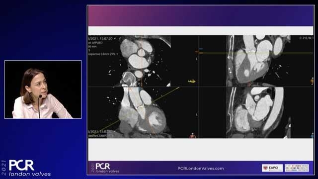Aortic valve disease: treatment and patient selection