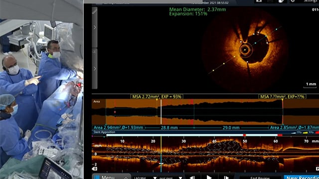 Approach to calcified lesions and role of plaque modification and intravascular imaging to obtain optimal PCI