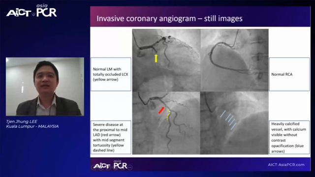 Cases on calcified lesions