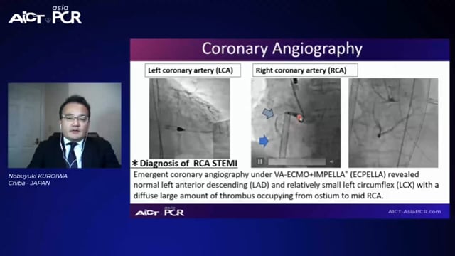 Cases on complications of coronary perforation: STEMI & NSTEMI