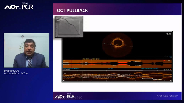 Cases on in-stent restenoses