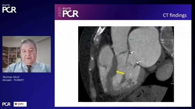 Challenging heart failure and mitral regurgitation cases