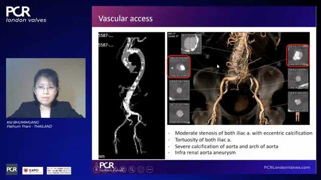 Challenging routes for TAVI