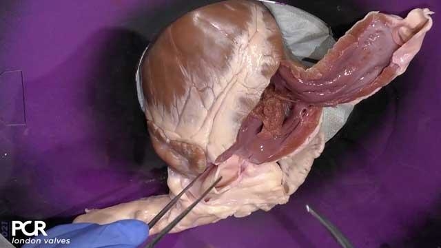 Coronary access following TAVI