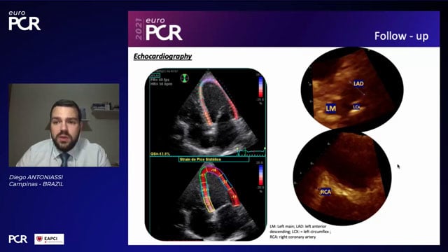 Coronary aneurysms: diagnosis, treatment and complications