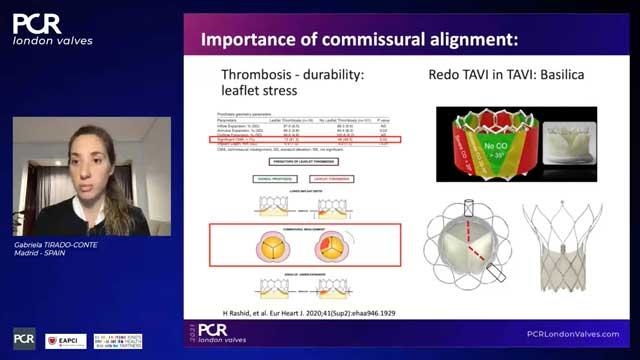 Coronary artery access and revascularisation after TAVI