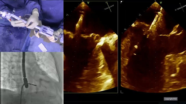 Edge-to-edge mitral valve repair : contemporary indications and techniques