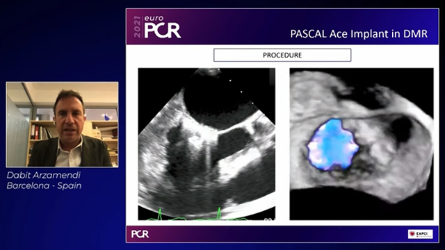 Embrace the future of mitral and tricuspid repair and replacement