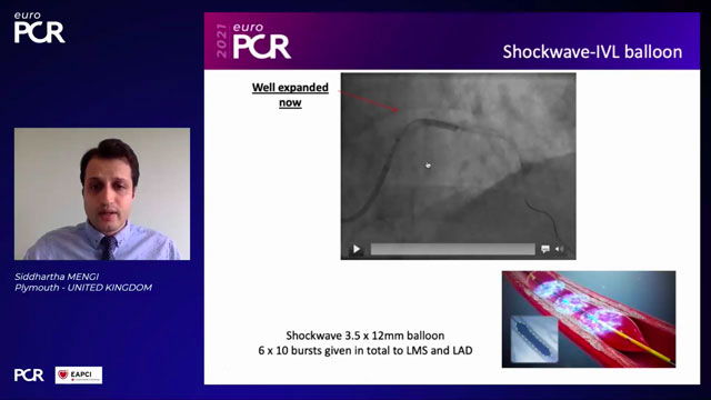 EuroPCR 2021 Calcified arteries: rotablation, lithotripsy or both? - Part 1