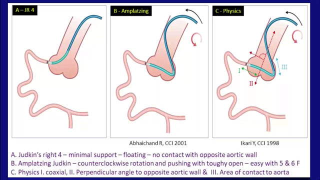 EuroPCR 2021 Calcified arteries: rotablation, lithotripsy or both? - Part 3