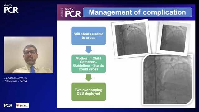 Complications: bifurcation lesions and left main