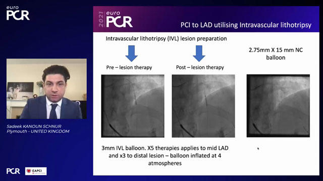 EuroPCR 2021 Complications during complex PCI