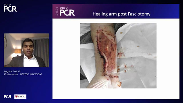 EuroPCR 2021 Complications during radial access