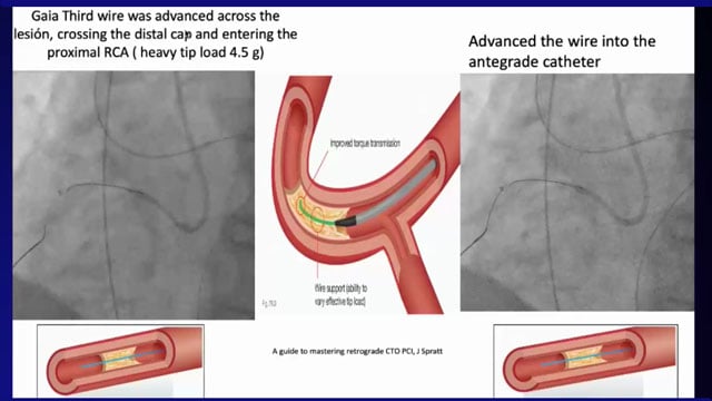 EuroPCR 2021 CTO: retrograde approach