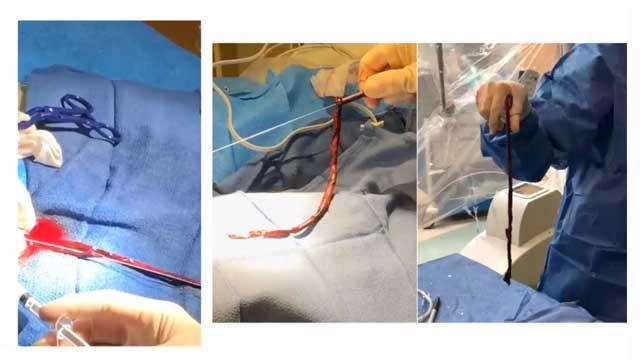 EuroPCR 2021 Deep vein and pulmonary interventions