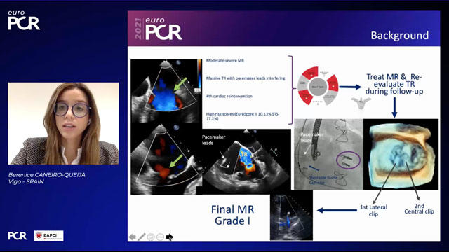 EuroPCR 2021 Percutaneous treatment of tricuspid regurgitation in 2021 - part 1