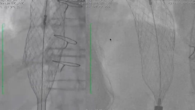 EuroPCR 2021 Percutaneous treatment of tricuspid regurgitation in 2021 - part 2