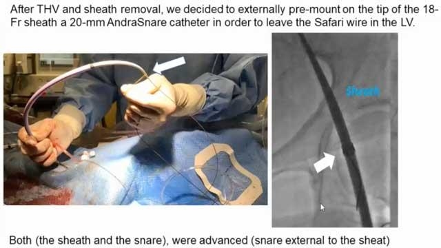 EuroPCR 2021 TAVI in a grey zone - Part 1