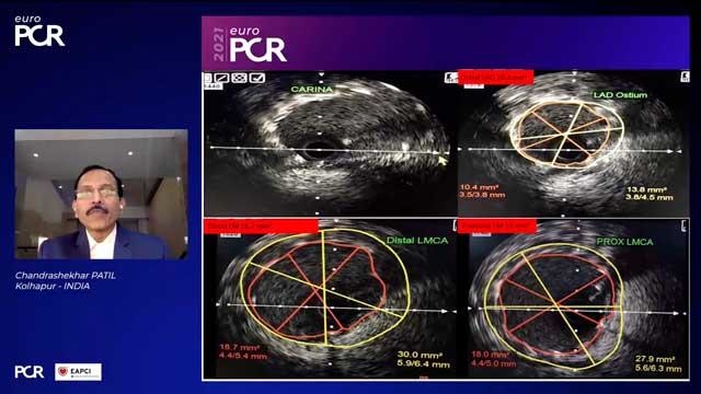 EuroPCR 2021 Unusual causes of stent failure