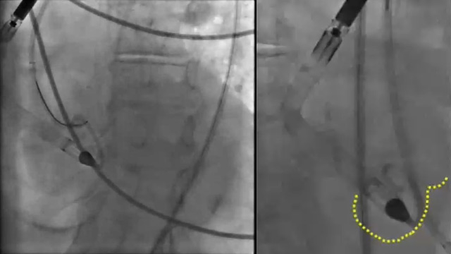 EuroPCR 2021 Unusual complications after peripheral interventions
