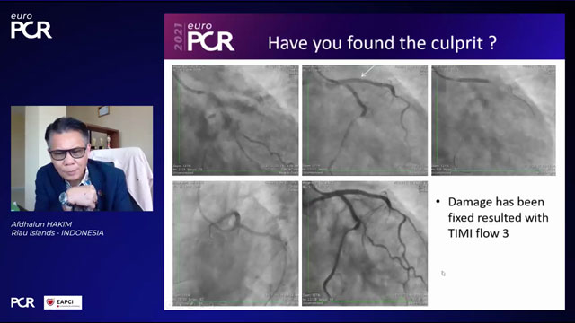 EuroPCR 2021 Coronary dissection - Part 2