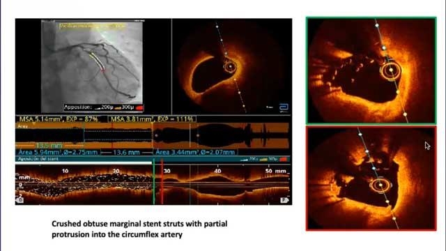 EuroPCR 2021 Role of imaging in enhancing PCI guidance