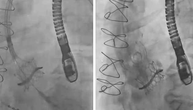 EuroPCR 2021 TAVI-in-Bioprostheses - never a dull moment