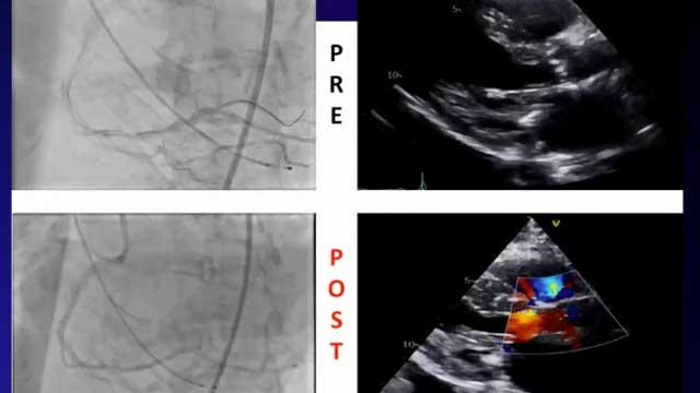 EuroPCR 2021 - TAVI in a grey zone - Part 2
