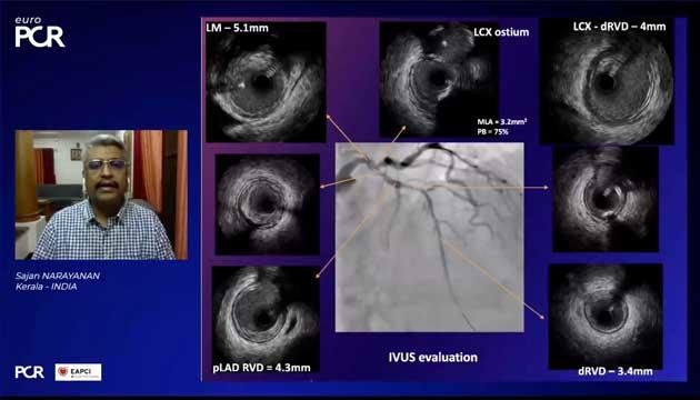 EuroPCR 2021 Treatment of bifurcation lesions
