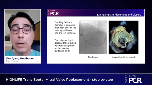 HIGHLIFE transseptal mitral valve replacement (TSMVR): step by step
