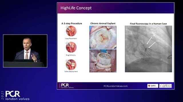 HighLife TSMVR study status and new developments