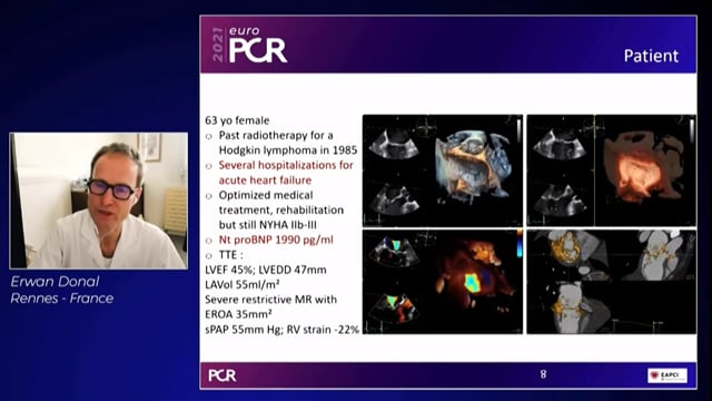 How CT fusion can empower your structural heart procedures