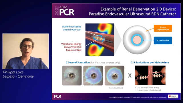 How does Paradise renal denervation fit into hypertension treatment management?