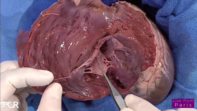 How to perform a tricuspid leaflet repair: anatomical landmarks, imaging guidance and basic device maneuvers