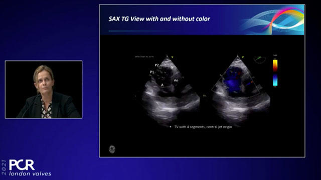 Innovation and imaging guidance for tricuspid valve replacement