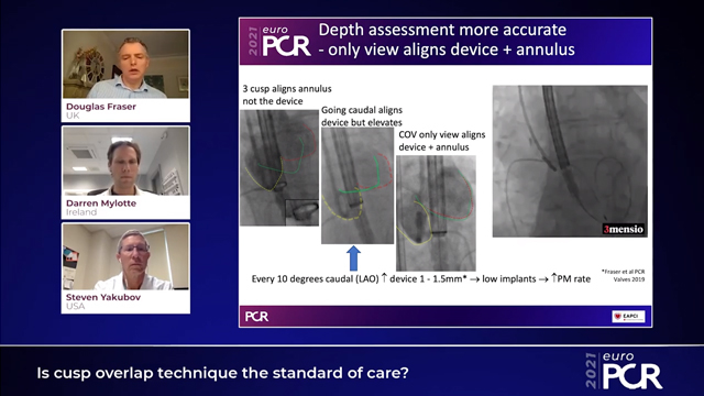 Is cusp overlap technique the standard of care?